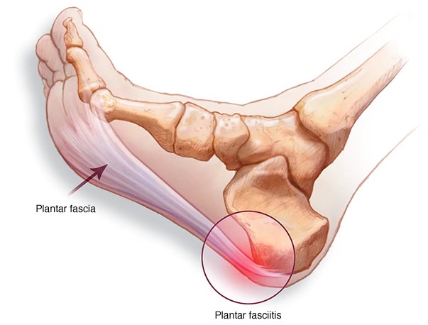 Estructura de pie al tener fascitis plantar