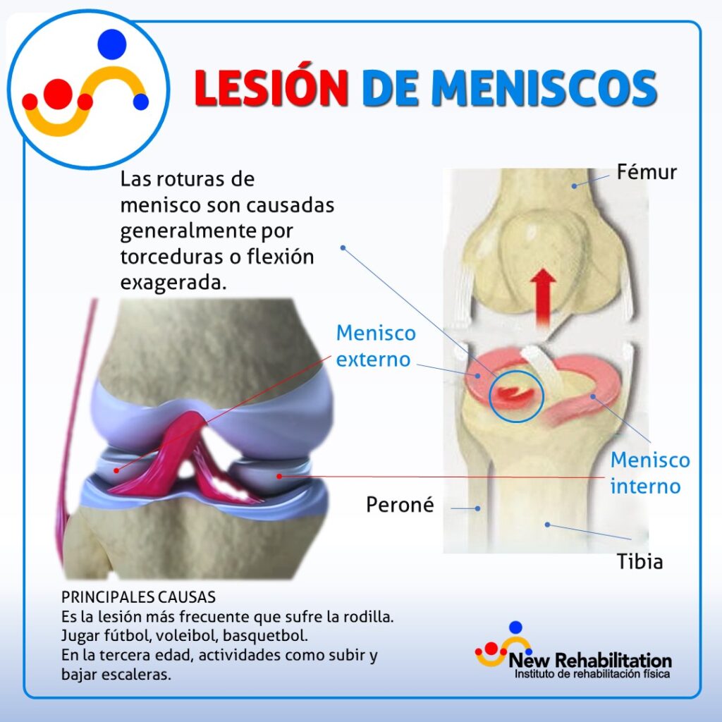 cuchara Banquete Para llevar Dolor de rodilla ¿meniscos rotos? , ¿cuáles son los síntomas?