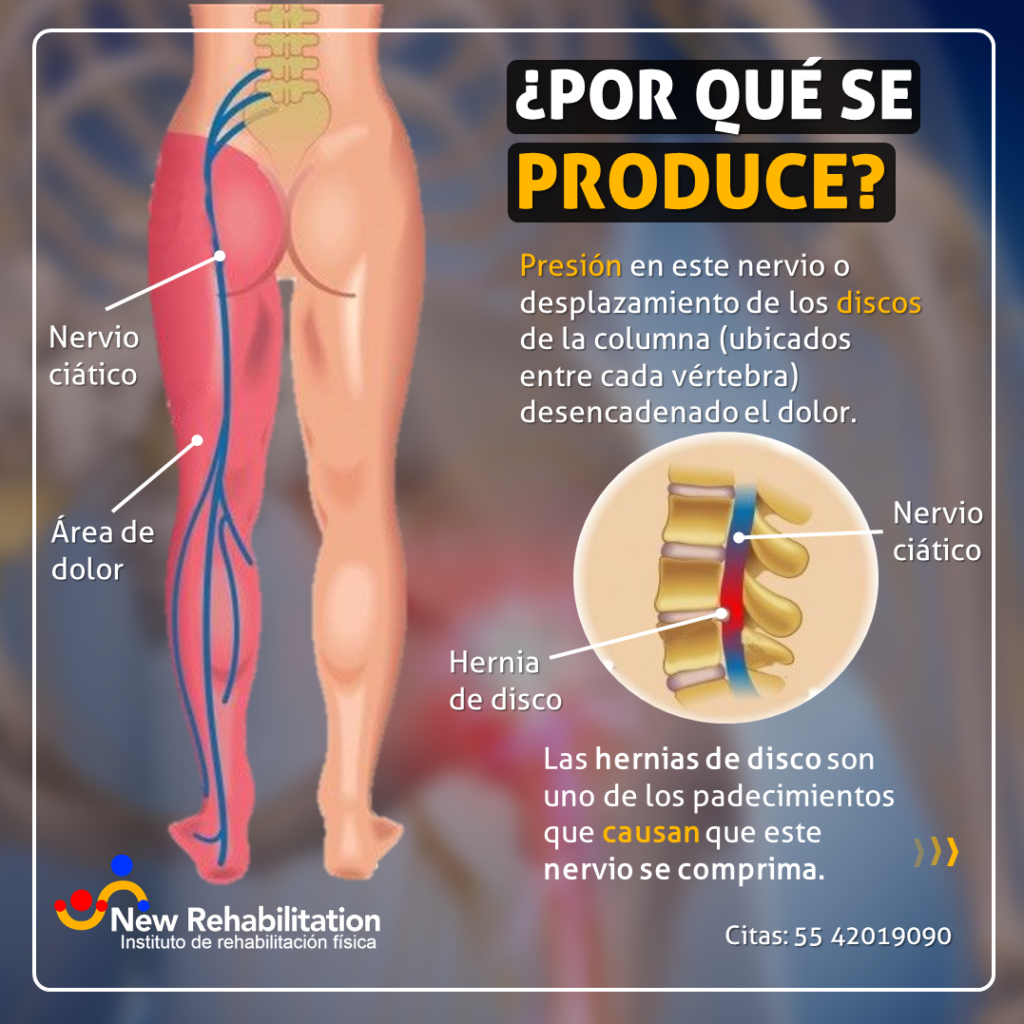 ¿Por qué se produce la ciática?