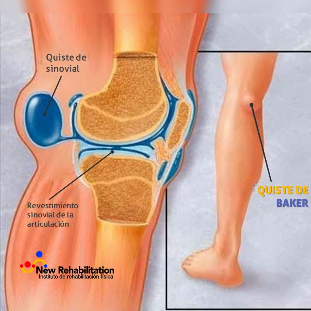 Líquido en la rodilla: Síntomas y tratamiento - Descubre el por