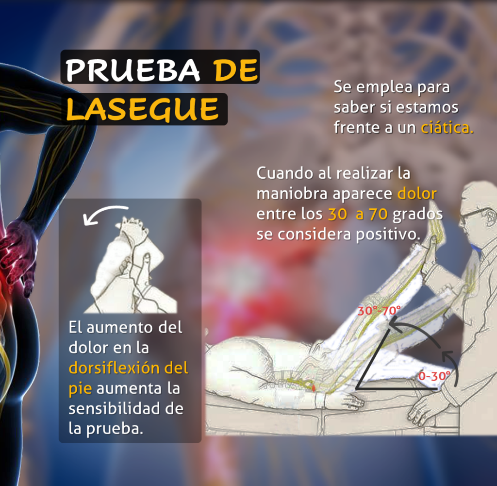 Maniobra de Lasègue positivo indicando un posible compresión radicular