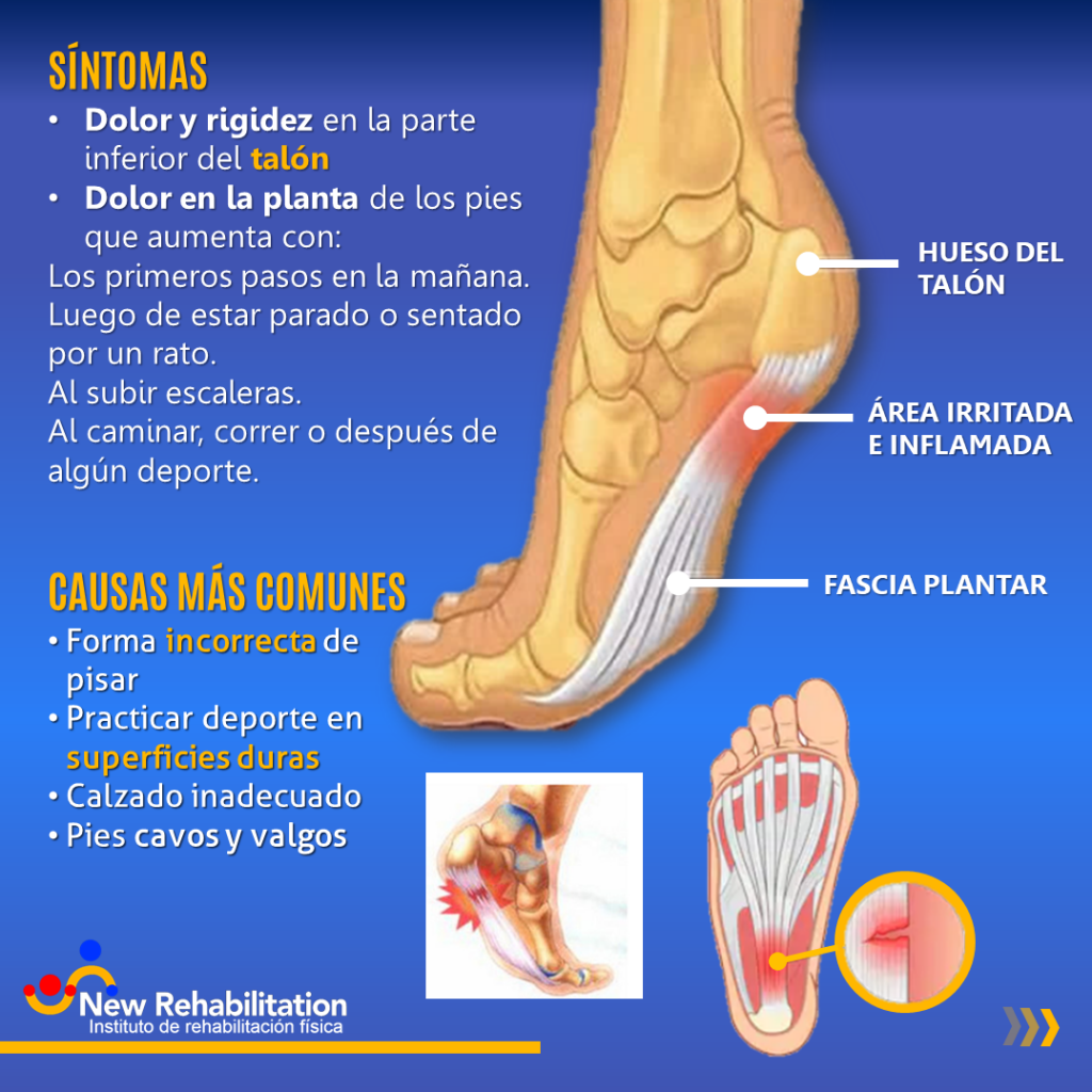 Síntomas y causas más comunes de la fascitis plantar